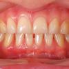 Déchaussement des gencives et alimentation - Les aliments à éviter ou privilégier en cas de gingivites. Si vos dents saignent au brossage, qu'elles deviennent mobiles, que vous observez une rétraction graduelle des gencives, voir une mauvaise...