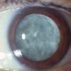 Traitement naturel Cataracte - Remèdes naturels pour soigner naturellement Opacification du cristallin. La cataracte est une maladie de l’œil qui se traduit par une opacification d'une ou de toutes les structures du cristallin. La vision...